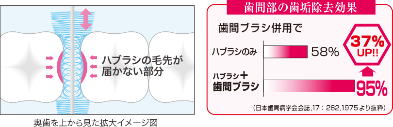 歯間ブラシ,歯周病,フロス,ケア