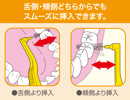 舌側、頬側どちらからでもスムーズに挿入できます