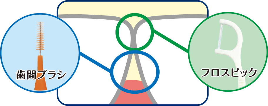 歯間ブラシ,歯周病,フロス,ケア